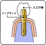 インプラント構造イメージ