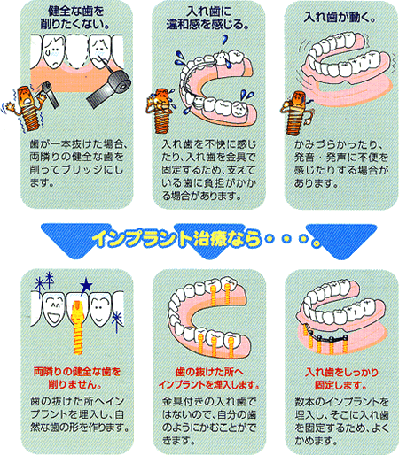 インプラント治療のメリット
