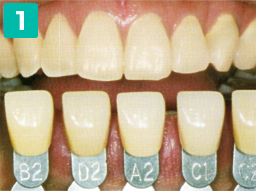 ホワイトニング施術ステップ
